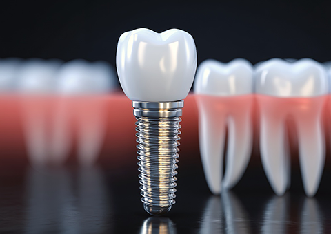 インプラントの再治療